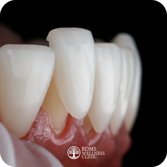 Are Veneers Right for You